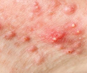 Čierne bodky môžu predstavovať predstupeň vzniku akné