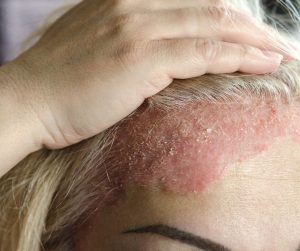 Psoriáza na koži hlavy je charakterizovaná vznikom šupinatých škvŕn na pokožke hlavy ktoré môžu sprevádzať svrbenie a suchosť