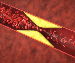 Trombóza je stav kedy sa v cievach vytvára nežiaduca krvná zrazenina