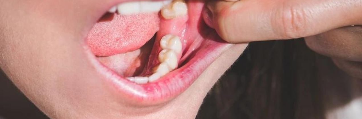 Biely povlak po extrakcii zuba Čo to je a ako sa tomu vyhnúť