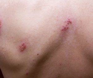 Po bolestiach sa často objavia červené alebo purpurové vyrážky ktoré sa môžu rozšíriť po jednej strane tela alebo tváre často v páse alebo pásovom tvare