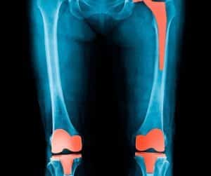 Artróza sa môže vyskytnúť v akomkoľvek kĺbe v tele