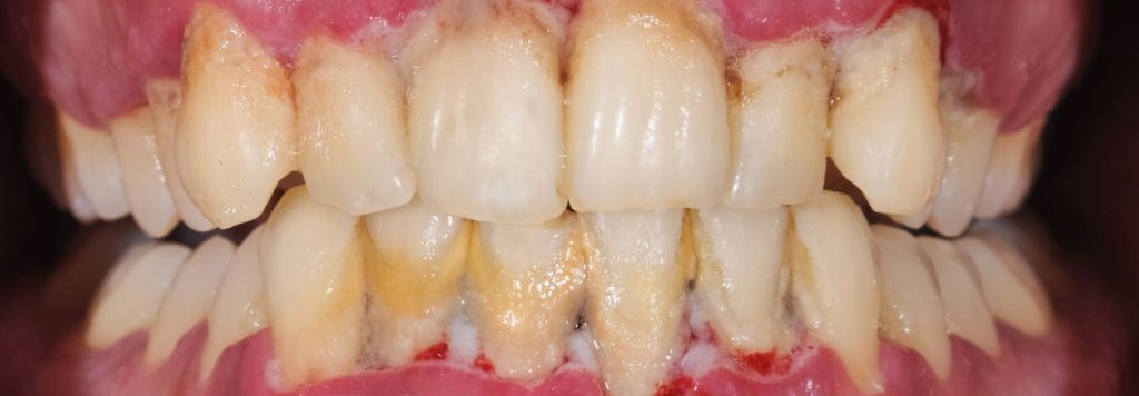 Nedostatočné čistenie zubov a nedostatok dentálnej kontroly môžu umožniť nahromadenie bakteriálneho plaku.