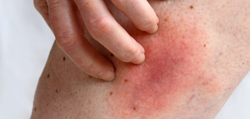 Vyrážky, ktoré sa rýchlo šíria alebo pokožka, ktorá sa začína intenzívne červenať, môže signalizovať alergickú reakciu.